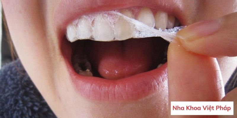 Tẩy trắng răng bằng miếng dán trắng răng