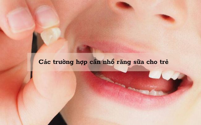 truong-hop-can-nho-rang-sua-cho-tre