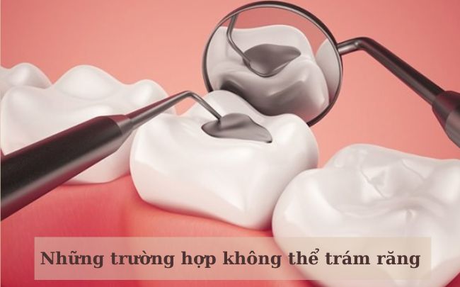 truong-hop-khong-the-tram-rang