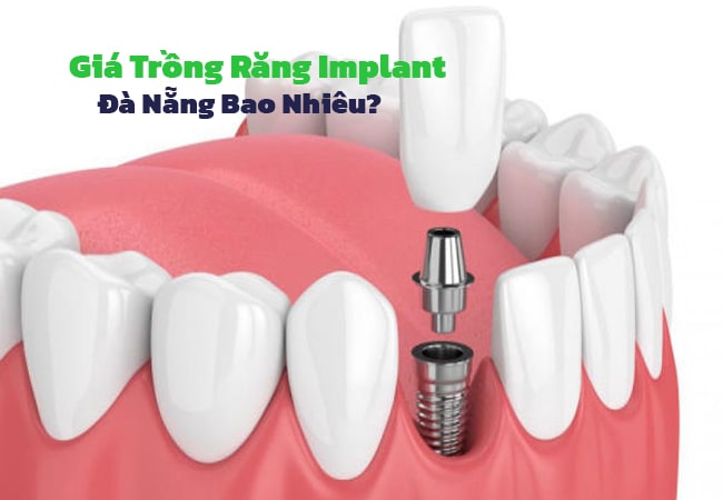 Giá trồng răng Implant Đà Nẵng cao hay thấp còn phụ thuộc vào nhiều yếu tố