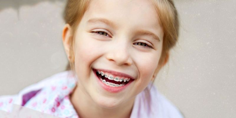 Có nên niềng răng cho trẻ em? 