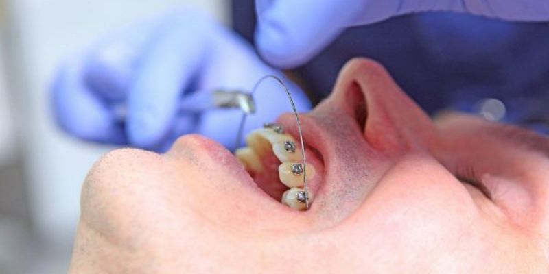 Các vấn đề thường gặp phải khi đeo dây cung niềng răng