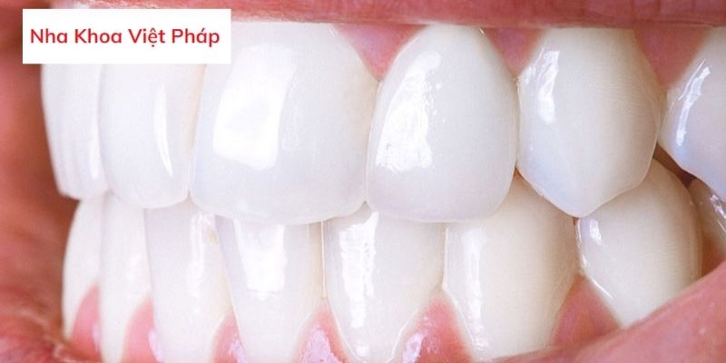 Khi nào nên tẩy trắng răng?