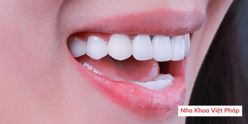 Tẩy trắng răng giá bao nhiêu tiền? 