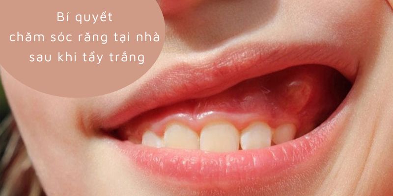 Bí quyết chăm sóc răng tại nhà sau khi tẩy trắng